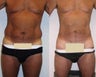 Liposuction