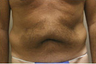 Liposuction