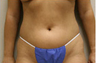 Liposuction