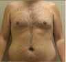Liposuction