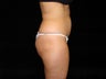 Buttocks Augmentation