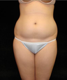 Liposuction