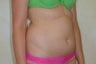 Liposuction