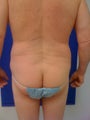 Laser Liposuction