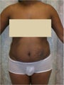 Laser Liposuction