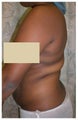 Laser Liposuction