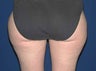 Thigh Liposuction