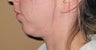 liposuction of double chin