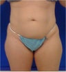 Thigh Liposuction