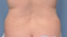 Liposuction