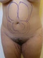 Liposuction of the abdomen