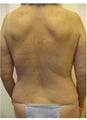 Liposuction of the back