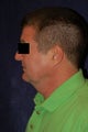 Liposuction
