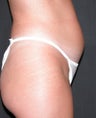 Liposuction