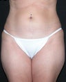 Liposuction