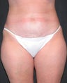 Liposuction