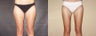 Liposuction Thighs