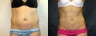 Liposuction of the Abdomen and Flanks