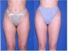 Liposuction