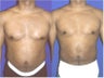 Liposuction