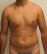 Male liposuction