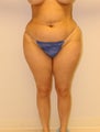 liposuction