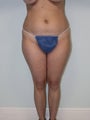 liposuction