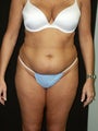 Liposuction