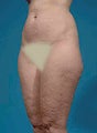 Liposuction