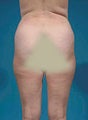 Liposuction
