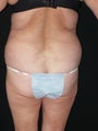 liposuction and tummy tuck