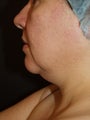 Liposuction Neck