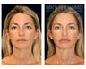 Liposuction - Jowls