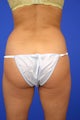 Liposuction