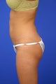Liposuction