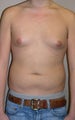 Liposuction