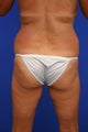 Liposuction
