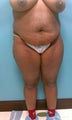 Liposuction
