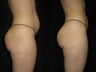 Liposuction Abdomen