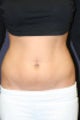 Liposuction of the abdomen, flanks, and hip rolls