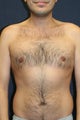 Liposuction of Abdomen and Flanks on Male