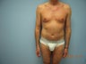 Liposuction