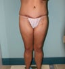 Liposuction and Fat Injection