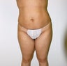 Liposuction and Fat Injectioni