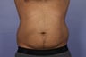 Liposuction