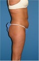Abdominal Liposuction