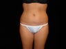 Liposuction