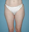 Liposuction