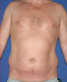 Liposuction of abdomen and flanks