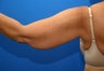 Liposuction - arms